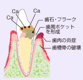 歯肉炎が悪化した状態の歯ぐきの断面図